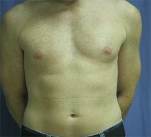 Liposuction Before