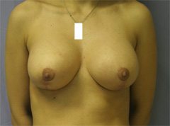 Mammaplasty - Mastopexy