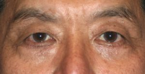 Eyelid After
