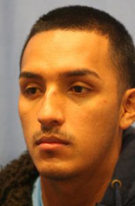 Rhinoplasty Before