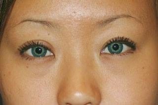 This patient has successfully undergone Dr. Byun's double eyelid blepharoplasty. Notice the dramatic difference given tot he upper eyelid fold and overall look of the eye. Absolutely beautiful.